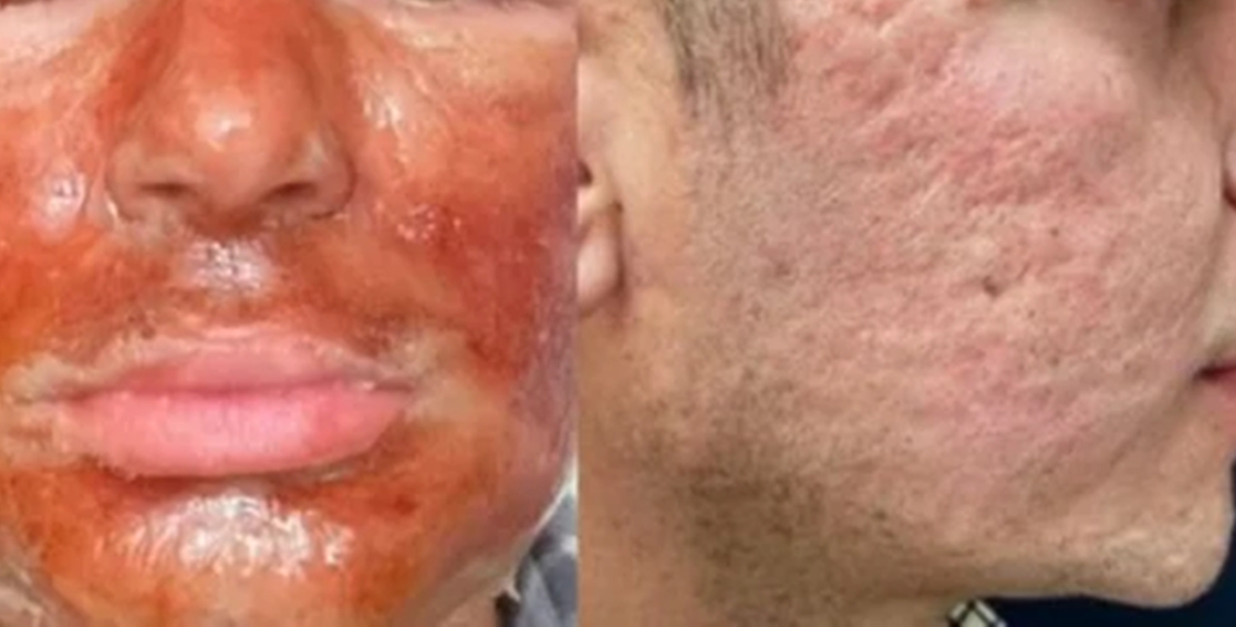 Peeling de Fenol: Explorando os Perigos por Trás da Busca pela Perfeição Dermatológica